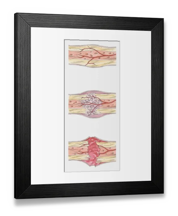 Framed Print : Sequence of illustrations showing complete bone fracture and healing process Framed Print : Sequence of illustrations showing complete bone fracture and healing process