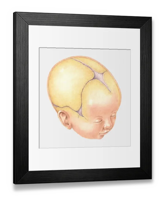 Framed Print : Illustration of Coronal Suture on head of newborn baby Framed Print : Illustration of Coronal Suture on head of newborn baby