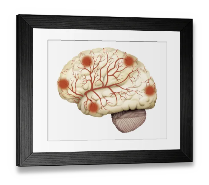Framed Print : Digital illustration of human brain showing blood vessels, and areas of dead tissue highlighted in red Framed Print : Digital illustration of human brain showing blood vessels, and areas of dead tissue highlighted in red