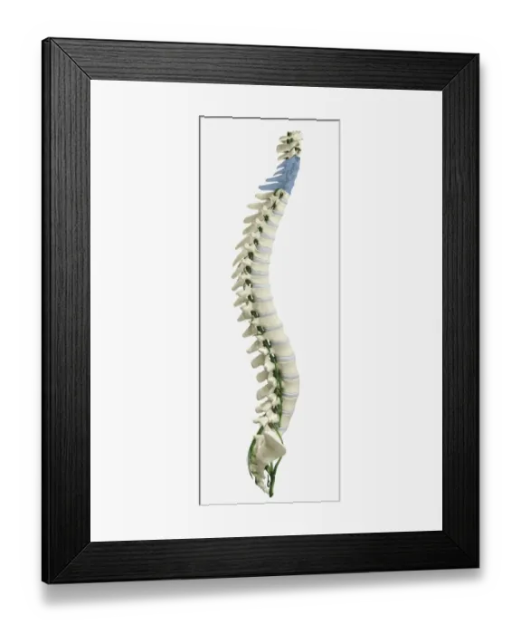 Framed Print : Digital illustration of human spine with damaged area highlighted in blue resulting in quadriplegia Framed Print : Digital illustration of human spine with damaged area highlighted in blue resulting in quadriplegia