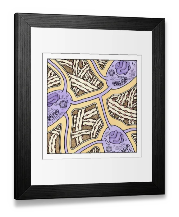 Framed Print : Illustration showing Osteoporosis in human bone Framed Print : Illustration showing Osteoporosis in human bone