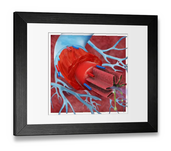 Framed Print : Digital cross section illustration of trachea and bronchioles in human lung of asthmatic Framed Print : Digital cross section illustration of trachea and bronchioles in human lung of asthmatic