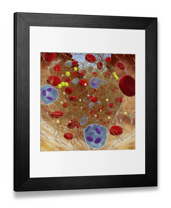 Framed Print : Cross section showing wound below skin, long fibrin threads trapping red blood, yellow platelets cau Framed Print : Cross section showing wound below skin, long fibrin threads trapping red blood, yellow platelets cau