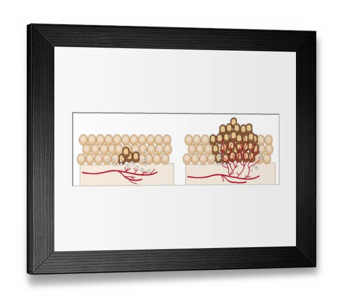 Framed Print : Digital illustration of angiogenesis process showing dormant tumour invading tissue, growing to mali Framed Print : Digital illustration of angiogenesis process showing dormant tumour invading tissue, growing to mali