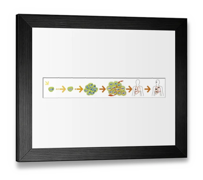 Framed Print : Digital illustration of the evolution of a cancer from initiation to metastasis Framed Print : Digital illustration of the evolution of a cancer from initiation to metastasis