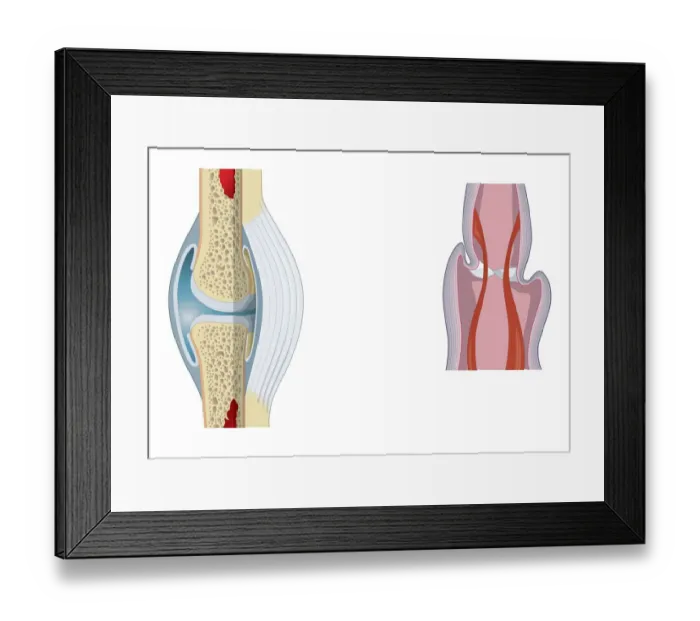 Framed Print : Digital illustration of invertebrate joint, left, and vertebrate joint, right Framed Print : Digital illustration of invertebrate joint, left, and vertebrate joint, right