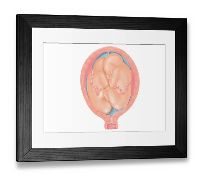 Framed Print : Cross section digital illustration of twins in breech position with buttocks presented first Framed Print : Cross section digital illustration of twins in breech position with buttocks presented first