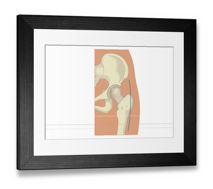 Framed Print : Digital illustration of prosthetic hip joint replacement Framed Print : Digital illustration of prosthetic hip joint replacement