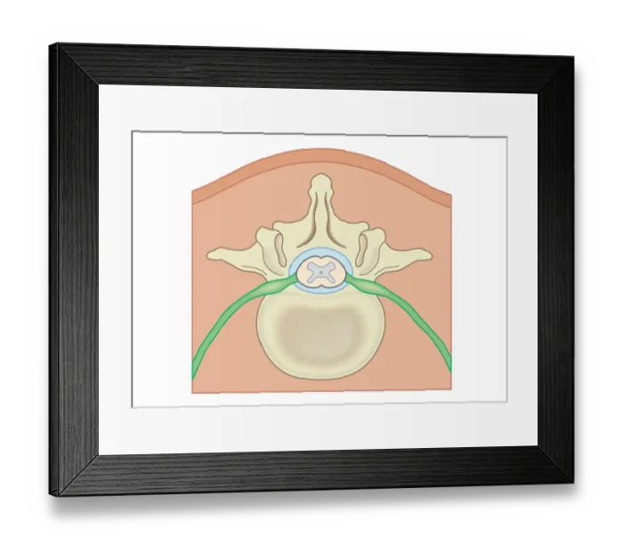 Framed Print : Digital illustration Spina Bifida, Meningocele, where protective covering around spinal cord protrudes through malformed vertebra to form sac filled with cerebrospinal fluid Framed Print : Digital illustration Spina Bifida, Meningocele, where protective covering around spinal cord protrudes through malformed vertebra to form sac filled with cerebrospinal fluid
