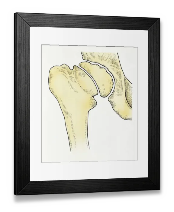 Framed Print : Digital illustration showing degeneration of hip joint known as Perthes disease Framed Print : Digital illustration showing degeneration of hip joint known as Perthes disease