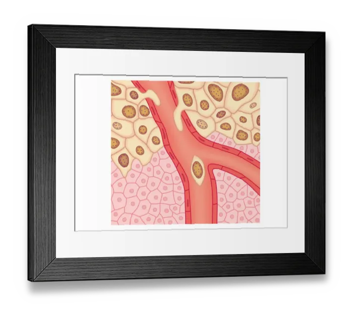 Framed Print : Digital illustration of blood vessel wall rupturing, primary tumour expanding, cells rupturing walls of blood vessels, enabling cancerous cells to detach and spread via blood flow Framed Print : Digital illustration of blood vessel wall rupturing, primary tumour expanding, cells rupturing walls of blood vessels, enabling cancerous cells to detach and spread via blood flow