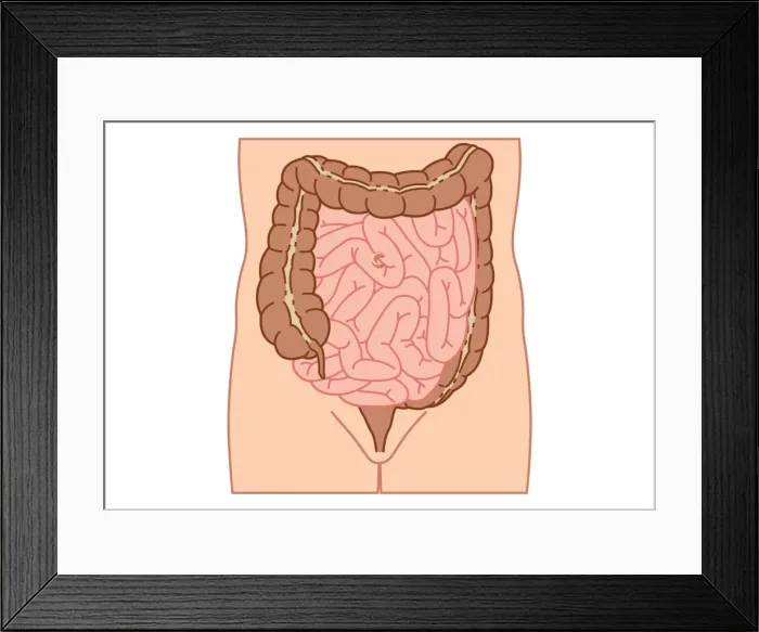 Framed Print : Digital illustration of location of intussusception in small intestine Framed Print : Digital illustration of location of intussusception in small intestine