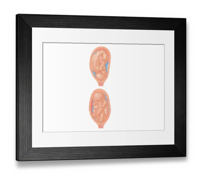 Framed Print : Cross section digital illustration of foetus in normal position and foetus in complete breech position with buttocks presented first Framed Print : Cross section digital illustration of foetus in normal position and foetus in complete breech position with buttocks presented first