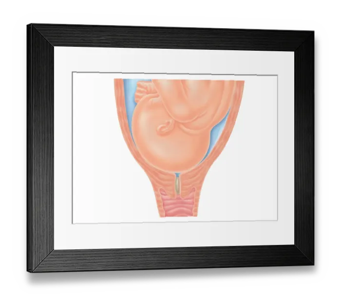 Framed Print : Cross section digital illustration of head of foetus in pelvis, pushing against cervix as labour nears, also showing mucus plug in cervix Framed Print : Cross section digital illustration of head of foetus in pelvis, pushing against cervix as labour nears, also showing mucus plug in cervix