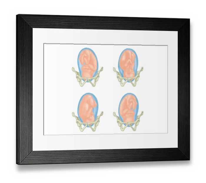 Framed Print : Four cross section digital illustrations showing head of foetus in pelvis Framed Print : Four cross section digital illustrations showing head of foetus in pelvis