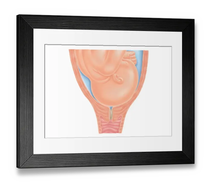 Framed Print : Cross section digital illustration of head of foetus in pelvis, pushing against cervix as labour nears, also showing mucus plug in cervix Framed Print : Cross section digital illustration of head of foetus in pelvis, pushing against cervix as labour nears, also showing mucus plug in cervix