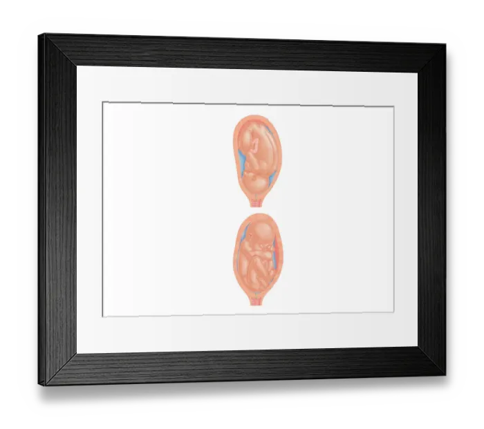 Framed Print : Cross section digital illustration of foetus in normal position and breech position Framed Print : Cross section digital illustration of foetus in normal position and breech position