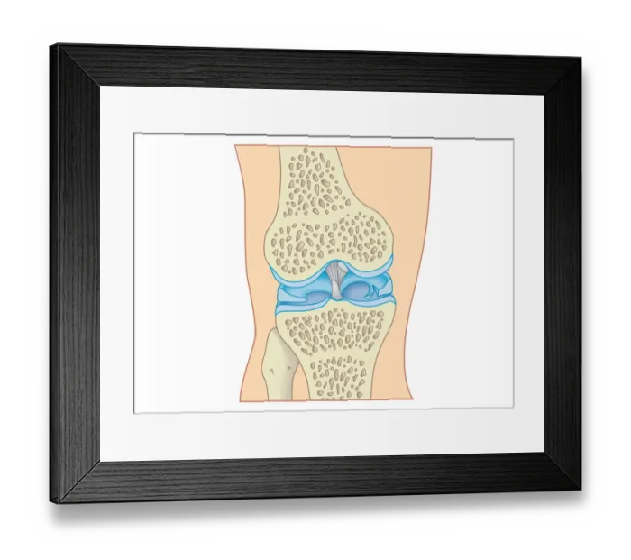 Framed Print : Digital cross section illustration of torn cartilage in knee