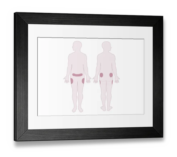 Framed Print : Digital illustration representing areas of fat distribution on belly, hips and thighs Framed Print : Digital illustration representing areas of fat distribution on belly, hips and thighs