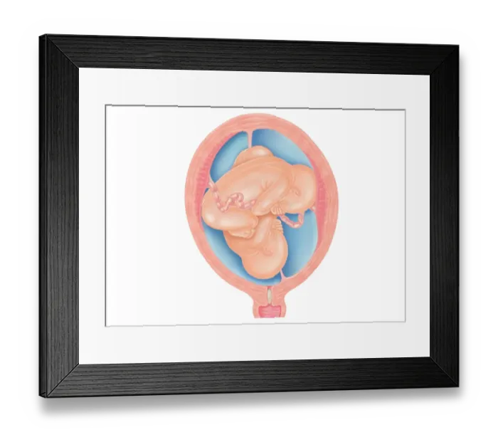 Framed Print : Cross section digital illustration of twins showing normal foetal presentation and transverse lie Framed Print : Cross section digital illustration of twins showing normal foetal presentation and transverse lie