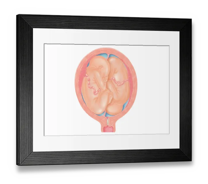 Framed Print : Cross section digital illustration showing normal and breech positions Framed Print : Cross section digital illustration showing normal and breech positions