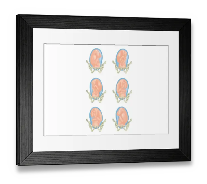 Framed Print : Six cross section digital illustrations of foetus showing position head in pelvis Framed Print : Six cross section digital illustrations of foetus showing position head in pelvis