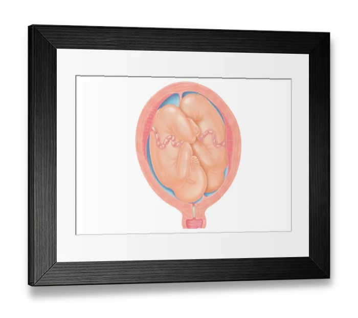Framed Print : Cross section digital illustration of twins in normal position in uterus Framed Print : Cross section digital illustration of twins in normal position in uterus