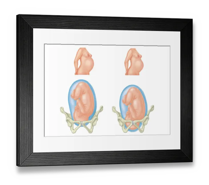 Framed Print : Digital illustration of pregnant two women and position of each babys head entering and inside pelvic area