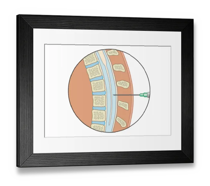 Framed Print : Digital illustration of lumbar puncture using spinal needle inserted into lumbar vertebrae and dura mater