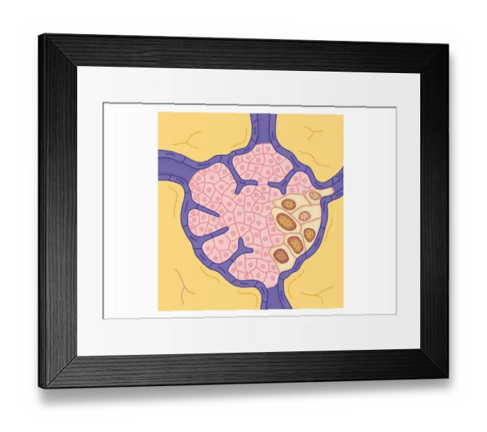 Framed Print : Digital illustration of tumour in lymph node Framed Print : Digital illustration of tumour in lymph node