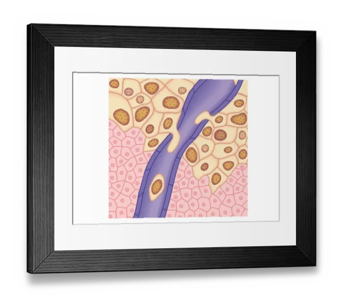 Framed Print : Digital illustration of breached lymph vessel as primary tumour grows and its cells invade adjacent tissues