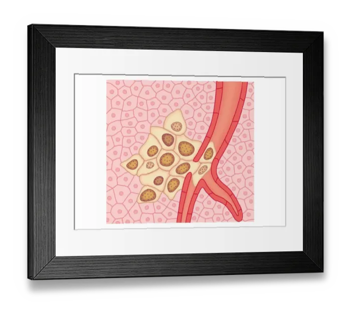 Framed Print : Digital illustration showing secondary tumour where cancerous cells have divided and lodged in narrow blood vessel and surrounding tissue Framed Print : Digital illustration showing secondary tumour where cancerous cells have divided and lodged in narrow blood vessel and surrounding tissue