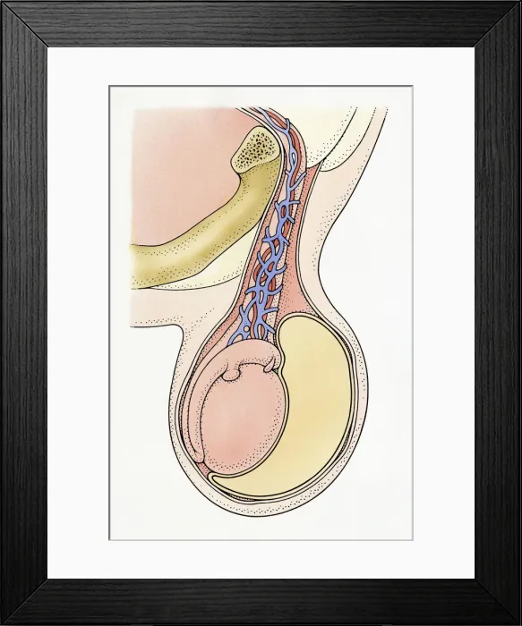Framed Print : Cross section Illustration showing infantile hydrocele testis, with clear, amber-coloured fluid from spermatic cord surrounding testicle, resulting in swelling Framed Print : Cross section Illustration showing infantile hydrocele testis, with clear, amber-coloured fluid from spermatic cord surrounding testicle, resulting in swelling