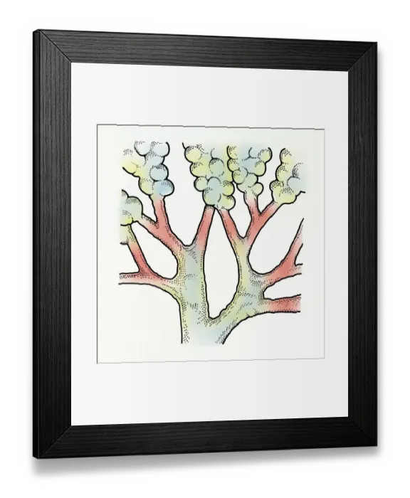 Framed Print : Illustration of inflamed bronchi causing breathing difficulties in childhood Framed Print : Illustration of inflamed bronchi causing breathing difficulties in childhood