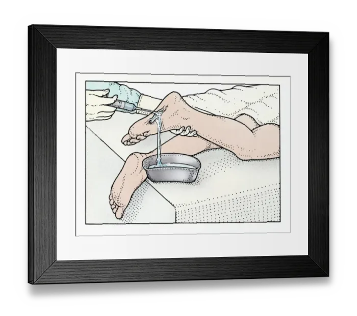 Framed Print : Illustration of using syringe to clean wound on sole of foot Framed Print : Illustration of using syringe to clean wound on sole of foot
