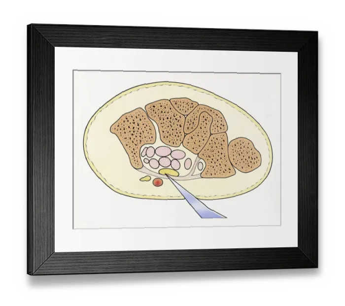 Framed Print : Illustration showing cross section of severed median nerve in wrist caused by sharp piece of glass penetrating skin