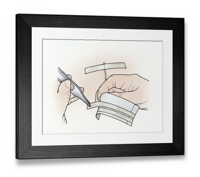 Framed Print : Illustration showing removal of butterfly stitches from adhesive paper using tweezers to apply to wound Framed Print : Illustration showing removal of butterfly stitches from adhesive paper using tweezers to apply to wound