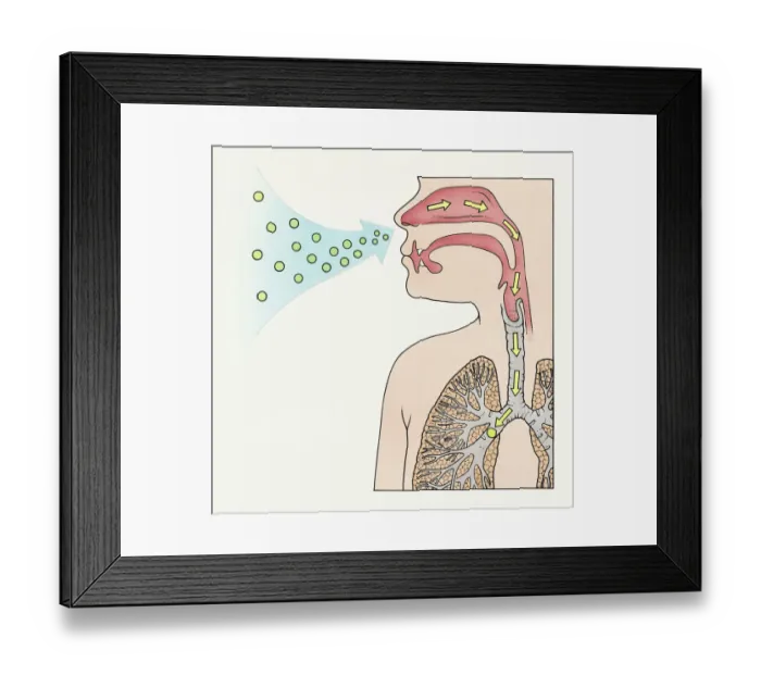 Framed Print : A diagram showing aspergilloma affecting human lung