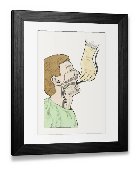 Framed Print : Diagram showing bronchoscope being inserted into patients throat Framed Print : Diagram showing bronchoscope being inserted into patients throat