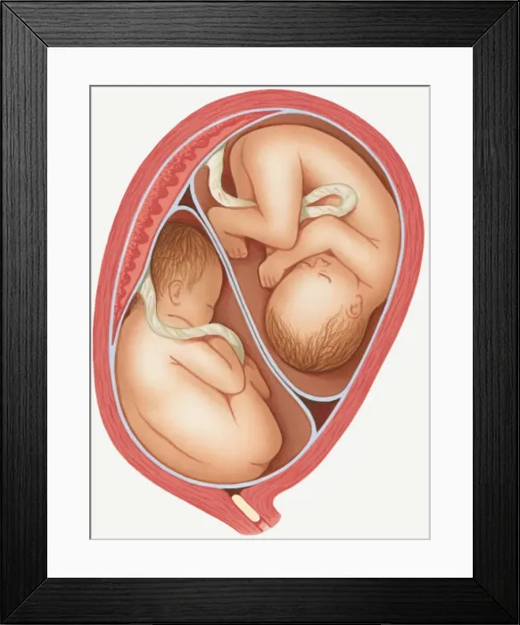Framed Print : Illustration of dizygotic twins in uterus, and mucus plug in cervix Framed Print : Illustration of dizygotic twins in uterus, and mucus plug in cervix