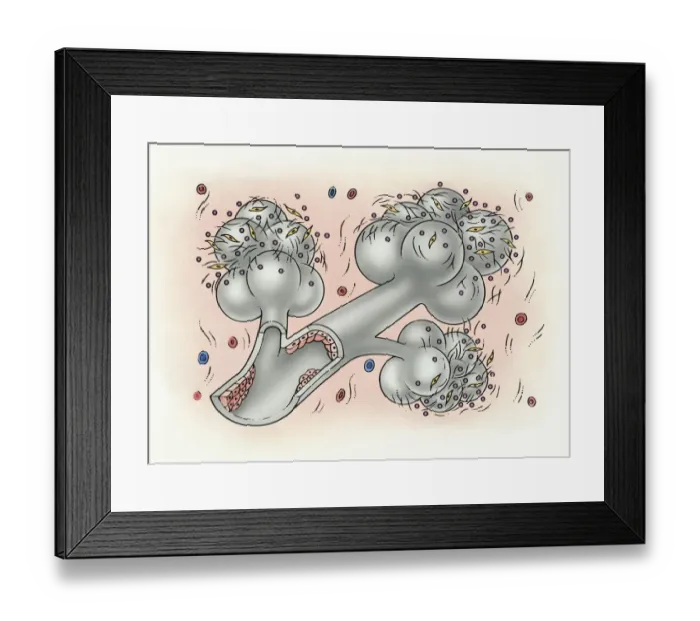 Framed Print : Illustration of bronchus and alveolus covered in inorganic particles, fibroblasts, and growth factor obstructing the internal lining Framed Print : Illustration of bronchus and alveolus covered in inorganic particles, fibroblasts, and growth factor obstructing the internal lining