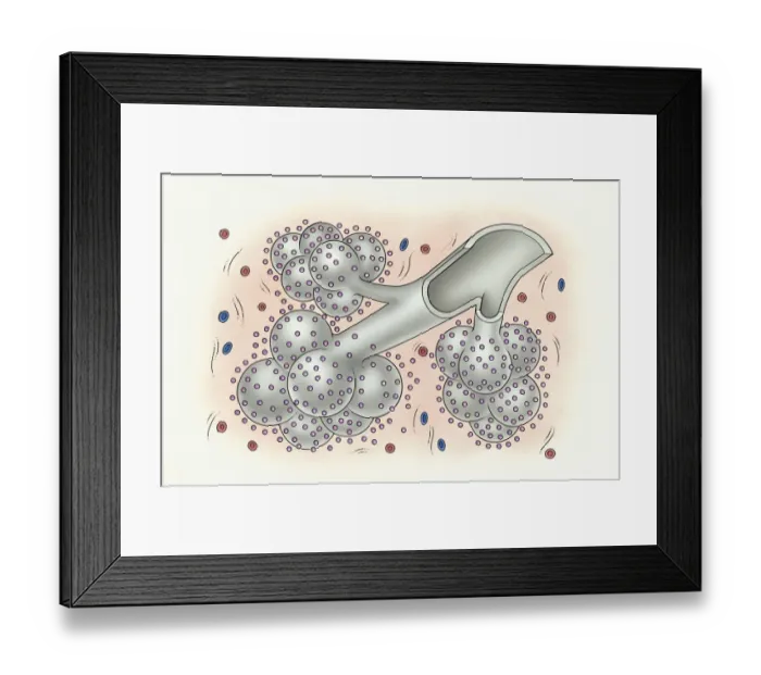 Framed Print : Illustration of development of idiopathic pulmonary fibrosis showing bronchus and alveolus covered in small inorganic particles