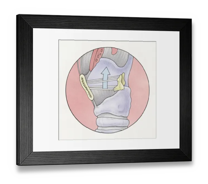 Framed Print : Illustration of human vocal cords and human larynx at top of trachea Framed Print : Illustration of human vocal cords and human larynx at top of trachea