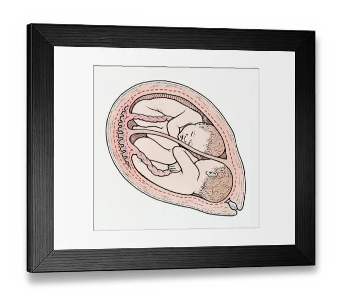 Framed Print : Illuystration of twin foetuses in normal position in cross section of human uterus Framed Print : Illuystration of twin foetuses in normal position in cross section of human uterus