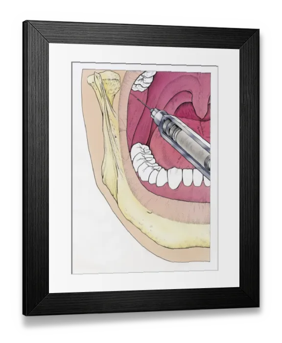 Framed Print : Illustration of injecting open human mouth using syringe seen in cross section showing jaw bone, teeth and epiglottis Framed Print : Illustration of injecting open human mouth using syringe seen in cross section showing jaw bone, teeth and epiglottis