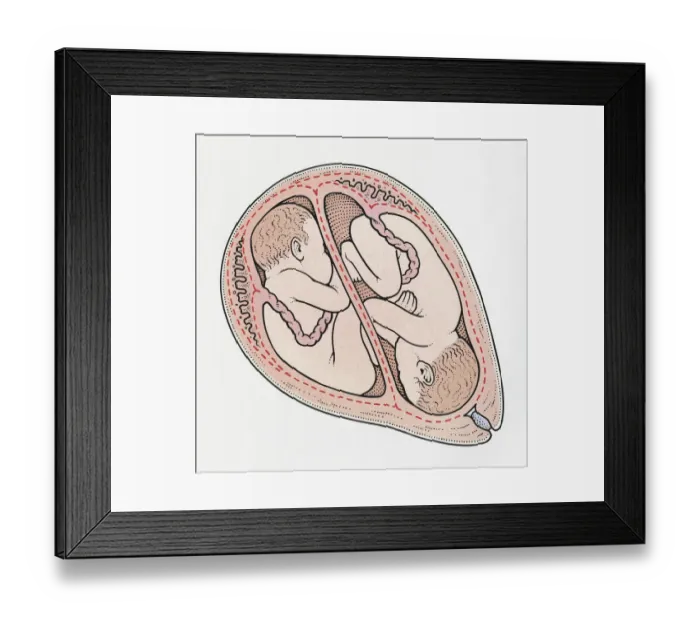 Framed Print : Illustration of twin foetuses in cross section of human uterus, one in breech position and the other in normal cephalic position Framed Print : Illustration of twin foetuses in cross section of human uterus, one in breech position and the other in normal cephalic position