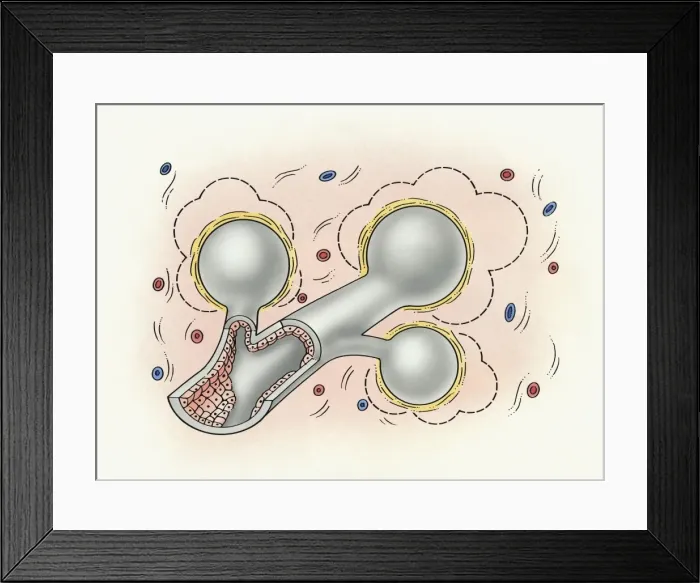 Framed Print : Illustration of human lung with small pulmonary alveolus surrounded by small particles causing inflammation to lining Framed Print : Illustration of human lung with small pulmonary alveolus surrounded by small particles causing inflammation to lining
