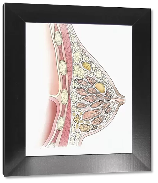 Illustration showing cyst, fibroadenoma, and fibrocystic disease in cross section of human breast