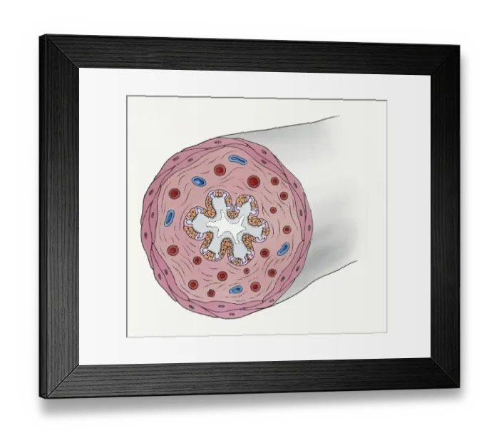 Framed Print : Cross section of narrowing of bronchus, veins and arteries during asthma attack Framed Print : Cross section of narrowing of bronchus, veins and arteries during asthma attack