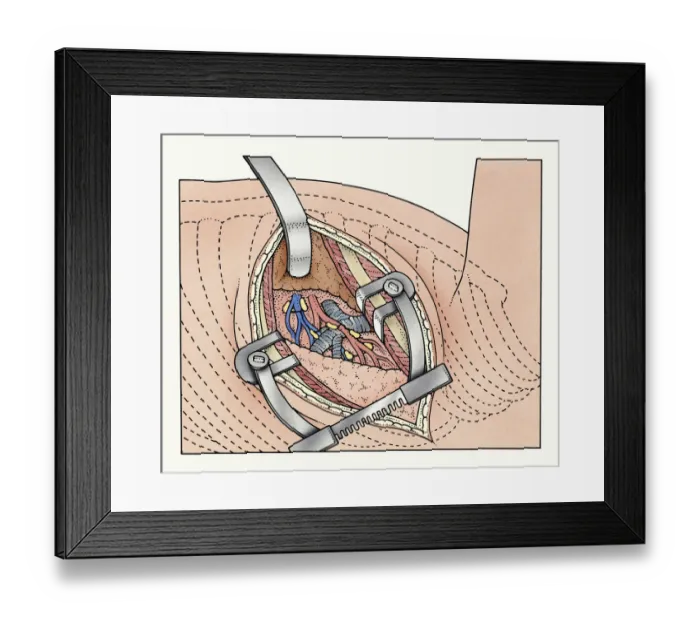 Framed Print : Illustration of abdominal incision between ribs kept open by spreaders exposing human lung and blood vessels Framed Print : Illustration of abdominal incision between ribs kept open by spreaders exposing human lung and blood vessels